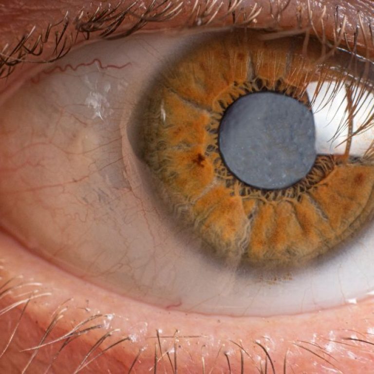 cirurgia-de-catarata-tudo-o-que-voce-precisa-saber-1