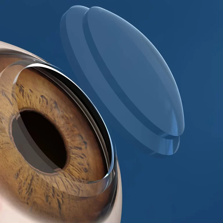 transplante-de-córnea